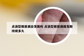 點(diǎn)滴型銀屑病會發(fā)展嗎 點(diǎn)滴型銀屑病爆發(fā)期持續(xù)多久