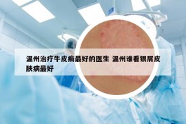 溫州治療牛皮癬最好的醫(yī)生 溫州誰看銀屑皮膚病最好