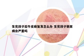 生完孩子后牛皮癬復發(fā)怎么辦 生完孩子銀屑病會嚴重嗎