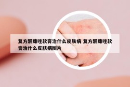 復方酮康唑軟膏治什么皮膚病 復方酮康唑軟膏治什么皮膚病圖片