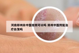 河南鄭州白中醫(yī)祛斑可以嗎 鄭州中醫(yī)院能治療白發(fā)嗎
