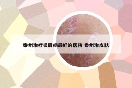 泰州治療銀屑病最好的醫(yī)院 泰州治皮膚