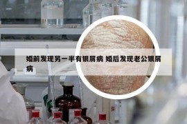 婚前發(fā)現(xiàn)另一半有銀屑病 婚后發(fā)現(xiàn)老公銀屑病
