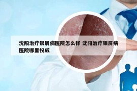 沈陽治療銀屑病醫(yī)院怎么樣 沈陽治療銀屑病醫(yī)院哪里權(quán)威