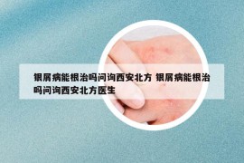銀屑病能根治嗎問(wèn)詢西安北方 銀屑病能根治嗎問(wèn)詢西安北方醫(yī)生