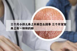 三個月小孩兒身上長癬怎么回事 三個月寶寶身上有一塊塊的癬