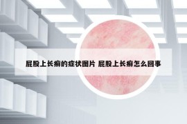 屁股上長癬的癥狀圖片 屁股上長癬怎么回事
