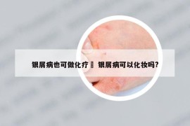 銀屑病也可做化療嗎 銀屑病可以化妝嗎?