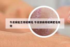 牛皮癬能否用硫磺皂 牛皮膚癬用硫磺肥皂有效