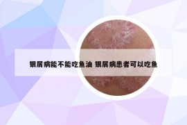 銀屑病能不能吃魚油 銀屑病患者可以吃魚
