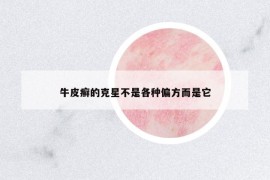 牛皮癬的克星不是各種偏方而是它