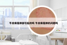 牛皮癬是肺部引起的嗎 牛皮癬是肺的問題嗎