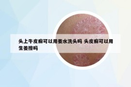頭上牛皮癬可以用姜水洗頭嗎 頭皮癬可以用生姜擦嗎