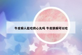 牛皮癬人能吃救心丸嗎 牛皮膚癬可以吃