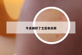 牛皮癬好了之后有白斑
