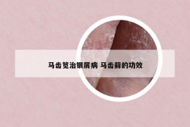 馬齒筧治銀屑病 馬齒蘚的功效