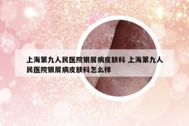 上海第九人民醫(yī)院銀屑病皮膚科 上海第九人民醫(yī)院銀屑病皮膚科怎么樣
