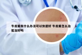 牛皮廨有什么辦法可以快速好 牛皮廨怎么治能治好嗎