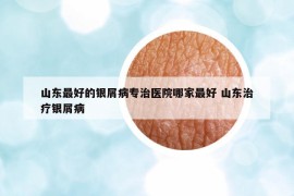 山東最好的銀屑病專(zhuān)治醫(yī)院哪家最好 山東治療銀屑病