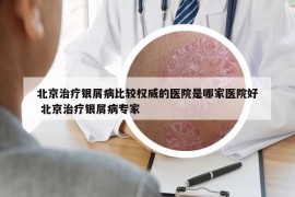 北京治療銀屑病比較權(quán)威的醫(yī)院是哪家醫(yī)院好 北京治療銀屑病專家