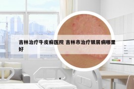 吉林治療牛皮癬醫(yī)院 吉林市治療銀屑病哪里好