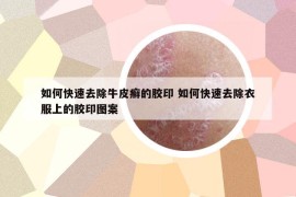 如何快速去除牛皮癬的膠印 如何快速去除衣服上的膠印圖案