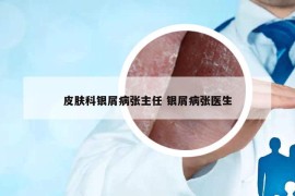 皮膚科銀屑病張主任 銀屑病張醫(yī)生