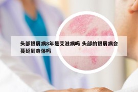頭部銀屑病8年是艾滋病嗎 頭部的銀屑病會蔓延到身體嗎