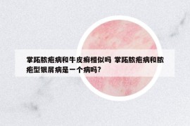 掌跖膿皰病和牛皮癬相似嗎 掌跖膿皰病和膿皰型銀屑病是一個(gè)病嗎?