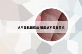 這不是你銀屑病 銀屑病不是真菌嗎