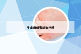 牛皮癬蜂蜜能治療嗎