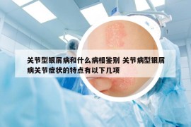 關(guān)節(jié)型銀屑病和什么病相鑒別 關(guān)節(jié)病型銀屑病關(guān)節(jié)癥狀的特點(diǎn)有以下幾項(xiàng)
