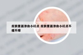 皮膚里面滲血小紅點(diǎn) 皮膚里面滲血小紅點(diǎn)不痛不癢