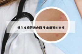 清牛皮癬勞務(wù)合同 牛皮癬簽約治療