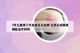 7歲兒童得了牛皮癬怎么辦啊 七歲小孩銀屑病能治療好嗎