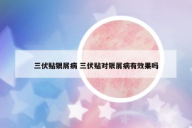 三伏貼銀屑病 三伏貼對(duì)銀屑病有效果嗎