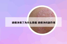 頑癬凈用了為什么很痛 頑癬凈的副作用