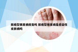 膿皰型銀屑病癌變嗎 膿皰型銀屑病是感染性皮膚病嗎