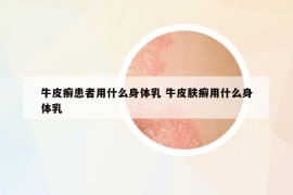 牛皮癬患者用什么身體乳 牛皮膚癬用什么身體乳