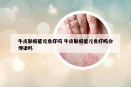 牛皮膚癬能吃魚蝦嗎 牛皮膚癬能吃魚蝦嗎會傳染嗎