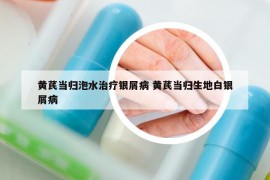 黃芪當(dāng)歸泡水治療銀屑病 黃芪當(dāng)歸生地白銀屑病