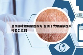 全國哪家銀屑病醫(yī)院好 全國十大銀屑病醫(yī)院排名公立們