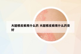 大腿根皮癬用什么藥 大腿根皮癬用什么藥膏好