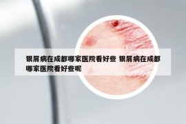 銀屑病在成都哪家醫(yī)院看好些 銀屑病在成都哪家醫(yī)院看好些呢