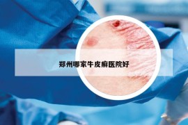 鄭州哪家牛皮癬醫(yī)院好