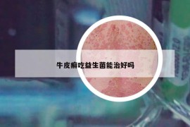 牛皮癬吃益生菌能治好嗎