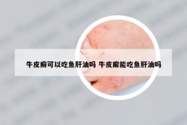 牛皮癬可以吃魚肝油嗎 牛皮廨能吃魚肝油嗎