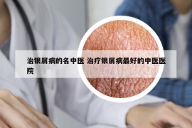 治銀屑病的名中醫(yī) 治療銀屑病最好的中醫(yī)醫(yī)院