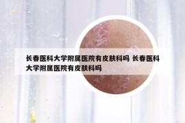 長(zhǎng)春醫(yī)科大學(xué)附屬醫(yī)院有皮膚科嗎 長(zhǎng)春醫(yī)科大學(xué)附屬醫(yī)院有皮膚科嗎