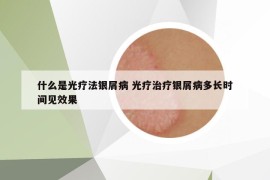 什么是光療法銀屑病 光療治療銀屑病多長時間見效果